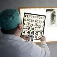 Tuberculosis