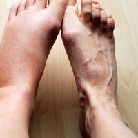 Inflammation